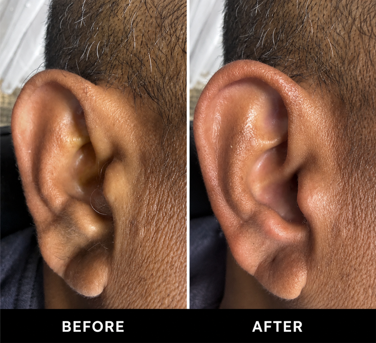 Real client ear waxing result