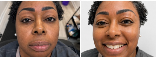 Real client full-face waxing result